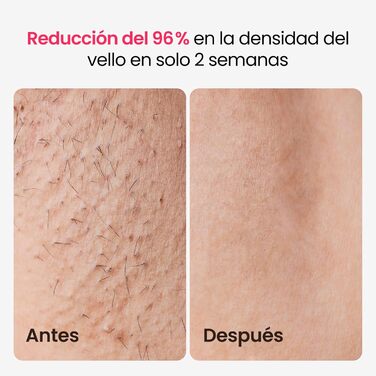 Пристрій для епіляції IPL з потрійним імпульсом, 12 см², охолодження сапфіровим льодом, лазерна епіляція для жінок та чоловіків, 3°C для безболісної та довготривалої епіляції вдома для обличчя, бікіні, інтимної зони (Champagne Gold)