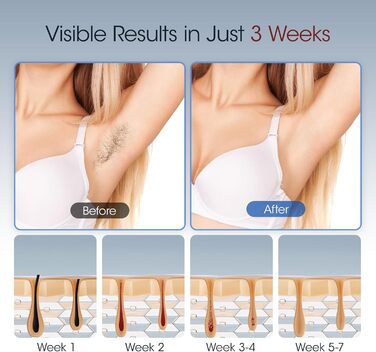 MLAY IPL пристрій для епіляції лазером: швидка та безболісна епіляція для тіла, обличчя та зони бікіні. Підходить для чоловіків та жінок. (Червоний)