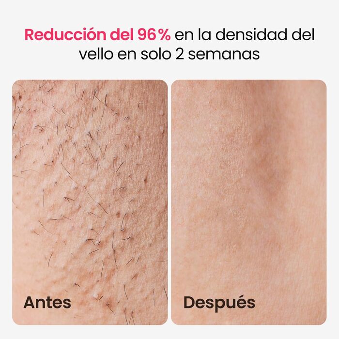 Пристрій для епіляції IPL з потрійним імпульсом, 12 см², охолодження сапфіровим льодом, лазерна епіляція для жінок та чоловіків, 3°C для безболісної та довготривалої епіляції вдома для обличчя, бікіні, інтимної зони (Champagne Gold)