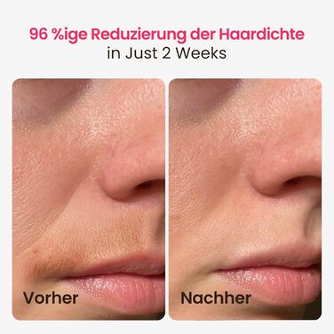 Пристрій для епіляції IPL, 25J, трипульсний лазер, для жінок та чоловіків, безболісна технологія охолодження сапфіром, довготривалий ефект для бікіні, ніг, пахв та тіла (темно-синій)