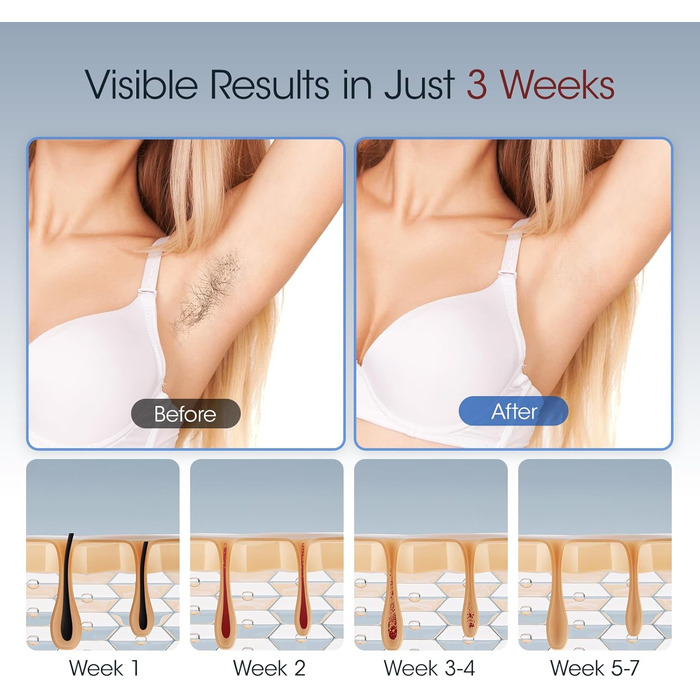 MLAY IPL пристрій для епіляції лазером: швидка та безболісна епіляція для тіла, обличчя та зони бікіні. Підходить для чоловіків та жінок. (Червоний)